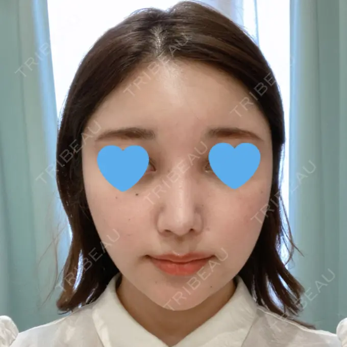 隆鼻術 / 鼻中隔延長（切開） / 軟骨移植 / ワシ鼻修正・ハンプ切除 みずほクリニック DAY 49 メイン用