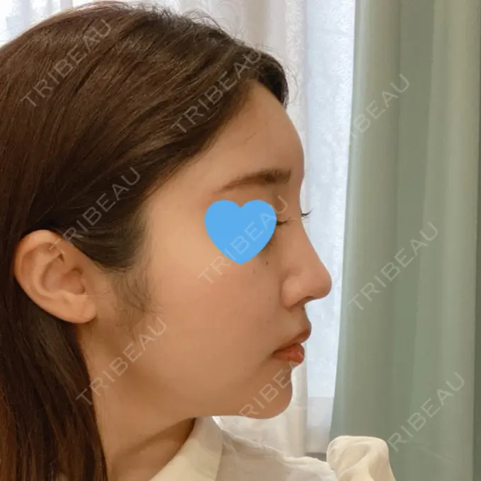 隆鼻術 / 鼻中隔延長（切開） / 軟骨移植 / ワシ鼻修正・ハンプ切除 みずほクリニック DAY 49 メイン用