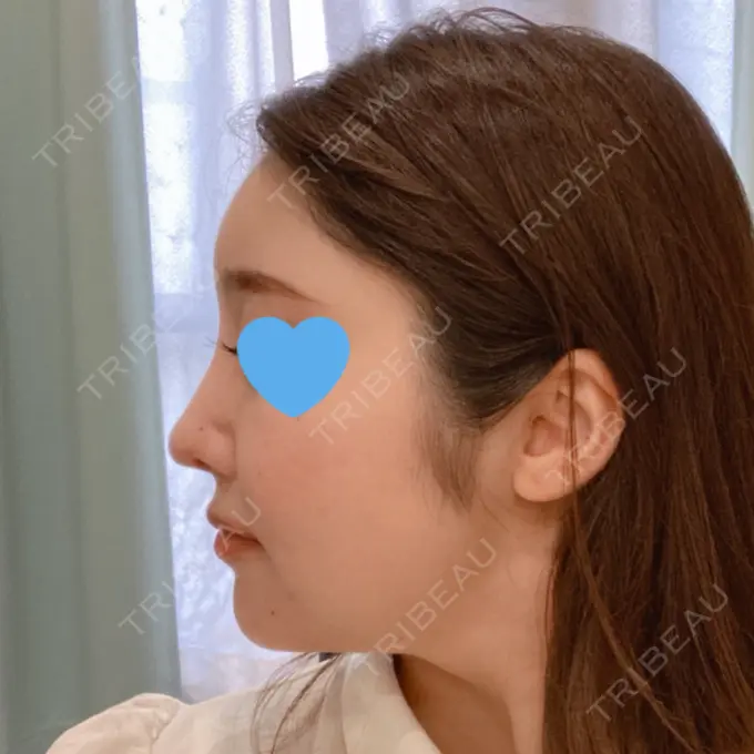 隆鼻術 / 鼻中隔延長（切開） / 軟骨移植 / ワシ鼻修正・ハンプ切除 みずほクリニック DAY 49 メイン用