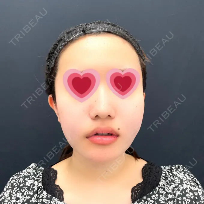 糸リフト / 脂肪吸引（顔） / メーラーファット除去 湘南美容クリニック 秋葉原院 DAY 0 メイン用