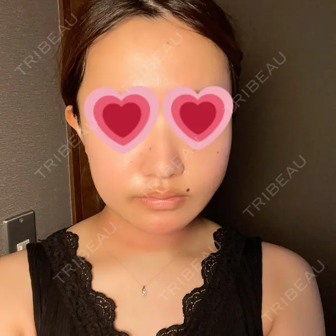 糸リフト / 脂肪吸引（顔） / メーラーファット除去 湘南美容クリニック 秋葉原院 DAY 1 メイン用