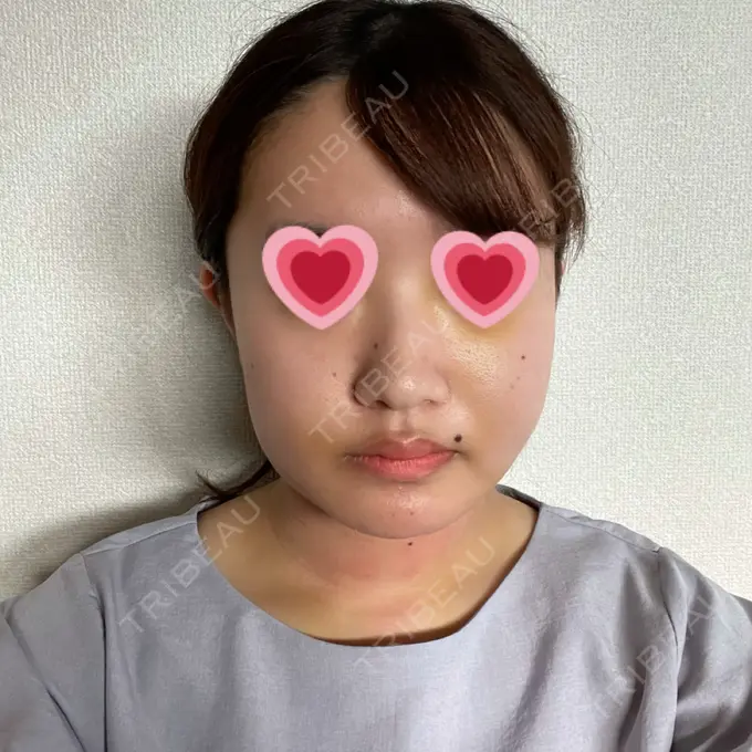 糸リフト / 脂肪吸引（顔） / メーラーファット除去 湘南美容クリニック 秋葉原院 DAY 3 メイン用