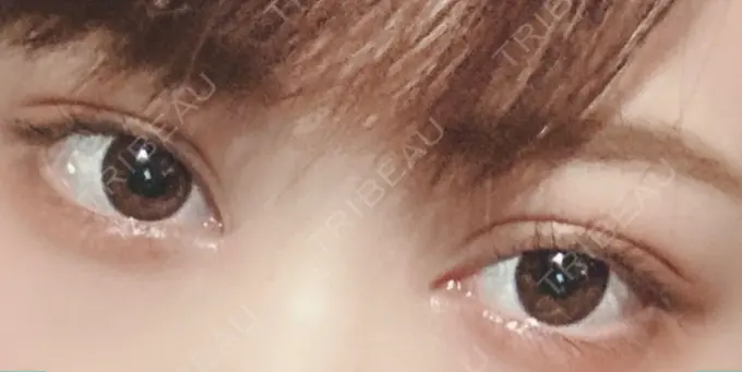 二重埋没 / 目頭切開 湘南メディカル記念病院（両国） AFTER メイン用