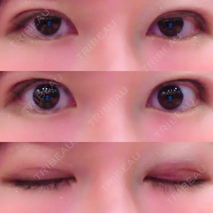 二重埋没 湘南美容クリニック 東京蒲田院 DAY 3 メイン用