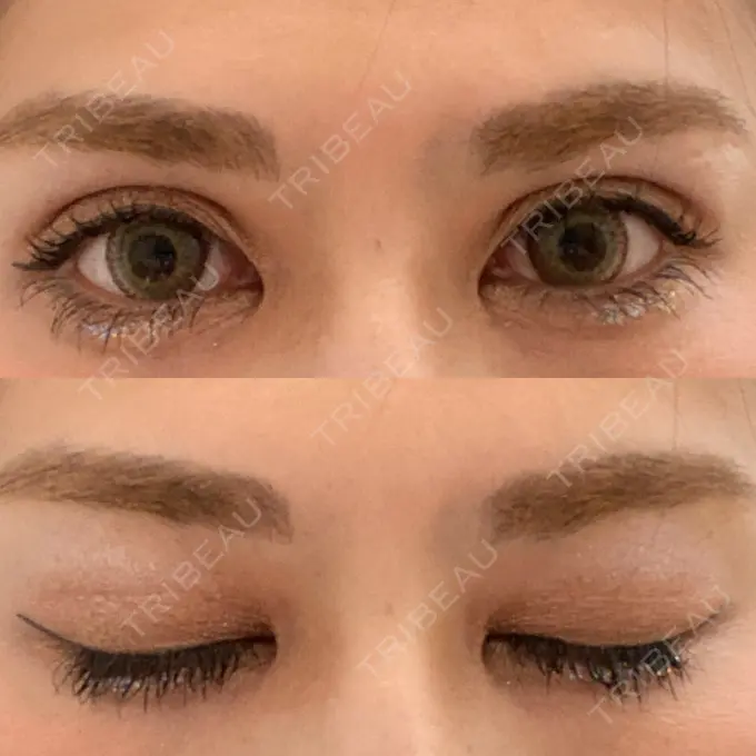 二重埋没 城本クリニック 福岡院 DAY 15 メイン用