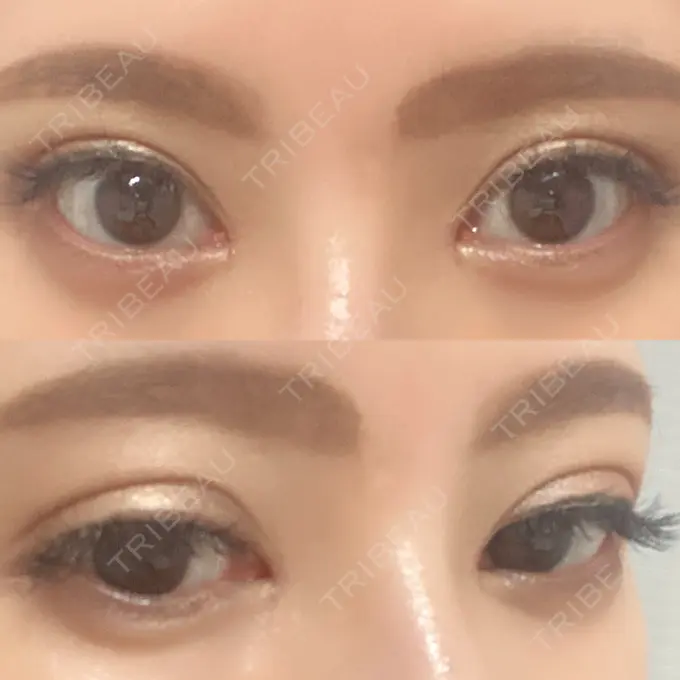 二重埋没 / 目頭切開 湘南メディカル記念病院（両国） DAY 53 メイン用