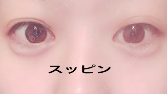 ヒアルロン酸注入（涙袋） しのぶ皮膚科 AFTER メイン用