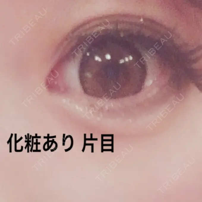 ヒアルロン酸注入（涙袋） しのぶ皮膚科 DAY 2 メイン用