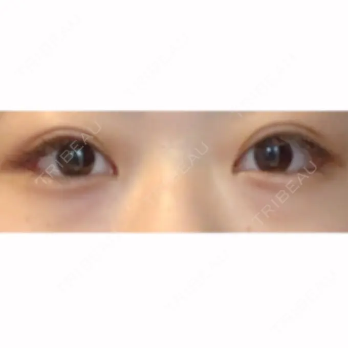 目尻切開 / タレ目形成・グラマラスライン（切開） / ボトックス（タレ目） A CLINIC（エークリニック） 銀座院 DAY 13 メイン用