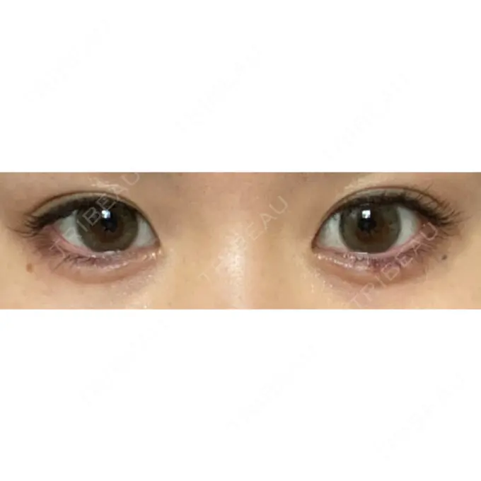 ヒアルロン酸注入（涙袋） Wクリニック 心斎橋院 AFTER メイン用