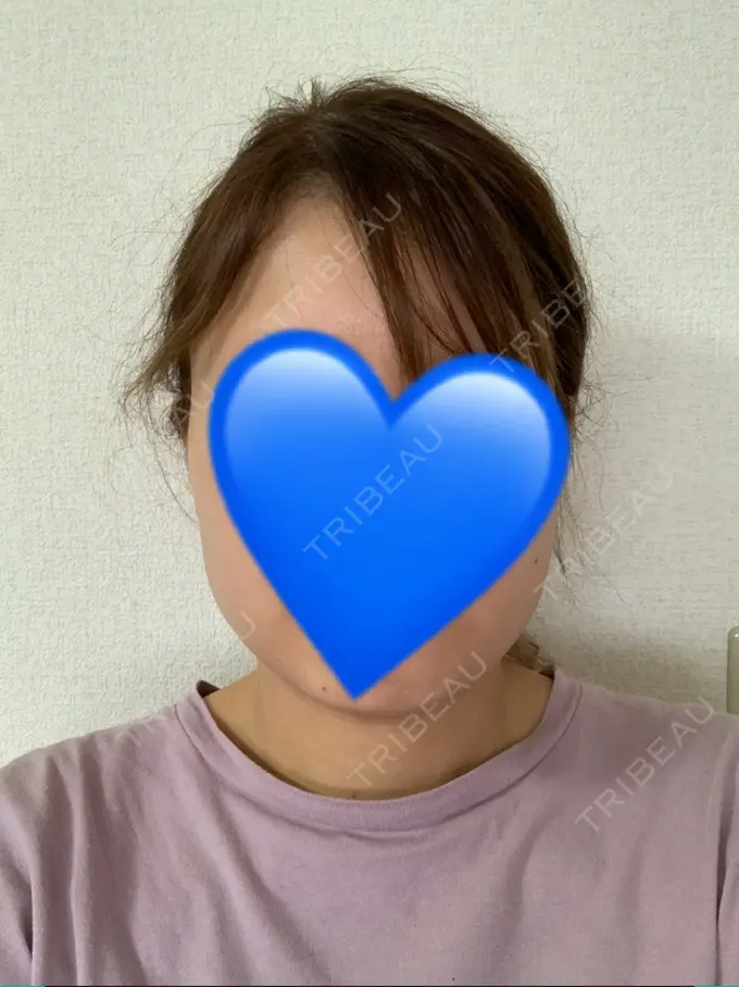 ボトックス（あご） / ボトックス（エラ・小顔） 湘南美容クリニック 名古屋栄院 DAY 67 メイン用