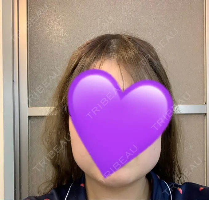 ボトックス（あご） / ボトックス（エラ・小顔） 湘南美容クリニック 名古屋栄院 DAY 67 メイン用