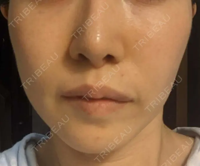 糸リフト / ボトックス（あご） / ヒアルロン酸注入（あご） フローラクリニック AFTER メイン用