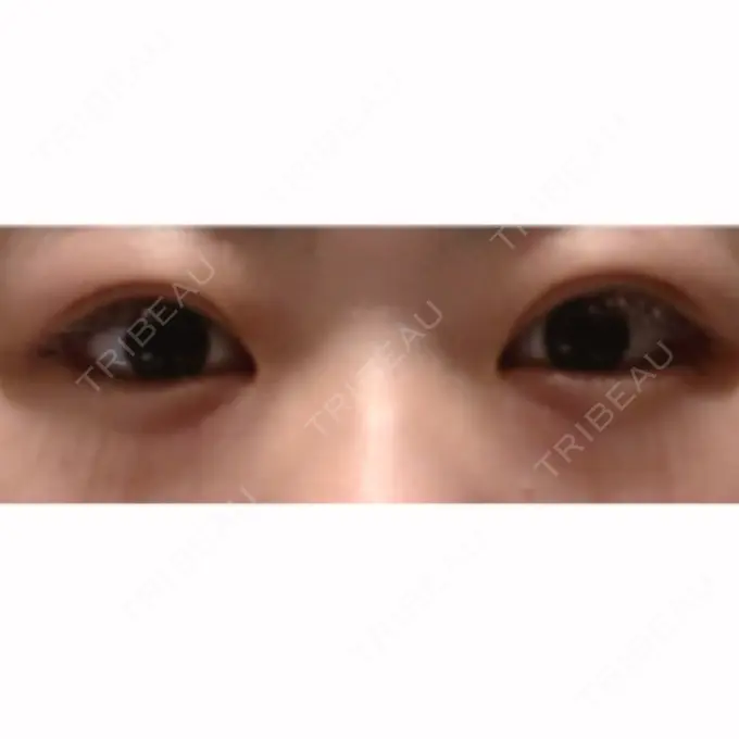 目尻切開 / タレ目形成・グラマラスライン（切開） / ボトックス（タレ目） A CLINIC（エークリニック） 銀座院 DAY 16 メイン用