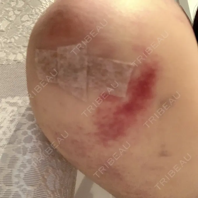 脂肪吸引（二の腕） THE CLINIC（ザ・クリニック） 福岡院 DAY 8 メイン用