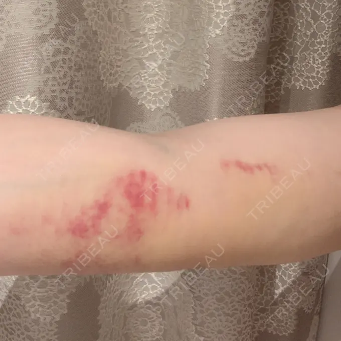 脂肪吸引（二の腕） THE CLINIC（ザ・クリニック） 福岡院 DAY 8 メイン用