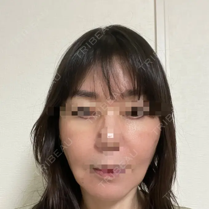 PRP皮膚再生療法 恵聖会クリニック 京橋院 AFTER メイン用