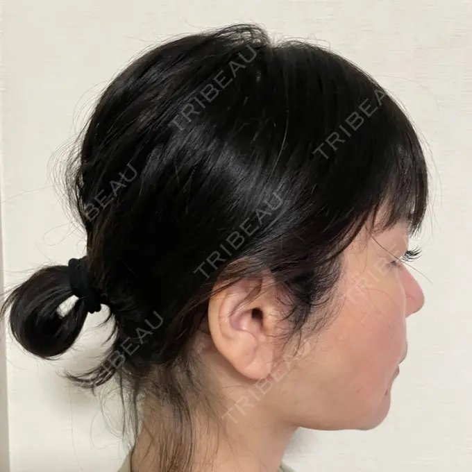 脂肪吸引（顔） / 切開リフト 恵聖会クリニック 京橋院 DAY 62 メイン用