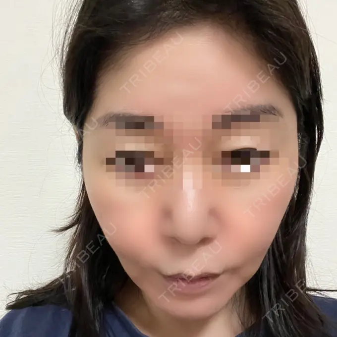 脂肪吸引（顔） / 切開リフト 恵聖会クリニック 京橋院 DAY 62 メイン用