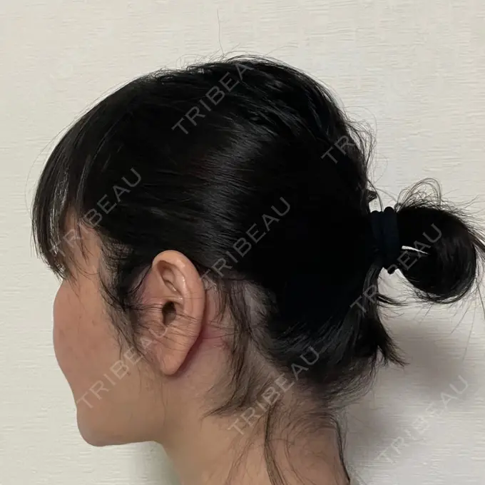 脂肪吸引（顔） / 切開リフト 恵聖会クリニック 京橋院 DAY 62 メイン用