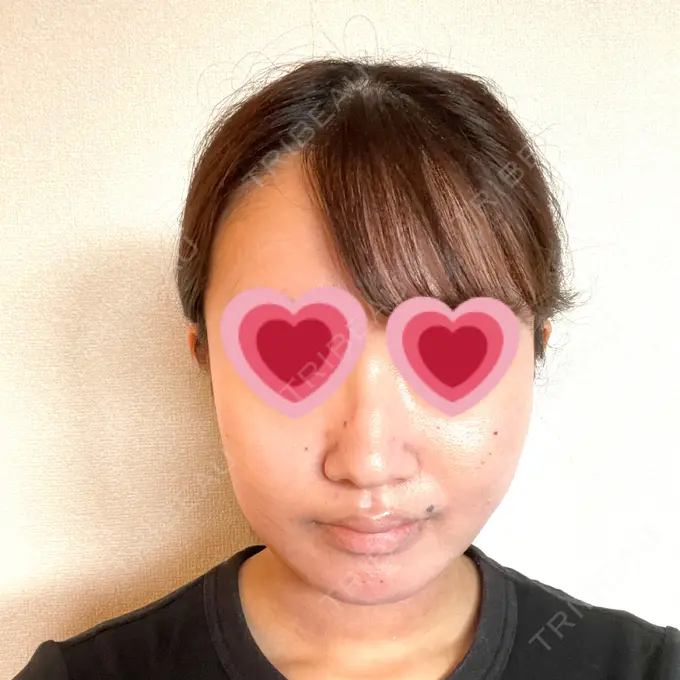 糸リフト / 脂肪吸引（顔） / メーラーファット除去 湘南美容クリニック 秋葉原院 DAY 7 メイン用