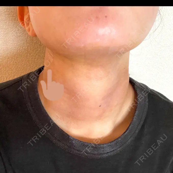 糸リフト / 脂肪吸引（顔） / メーラーファット除去 湘南美容クリニック 秋葉原院 DAY 7 メイン用