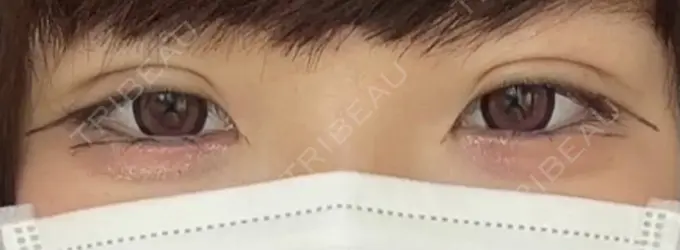 二重埋没 湘南メディカル記念病院（両国） DAY 2 メイン用