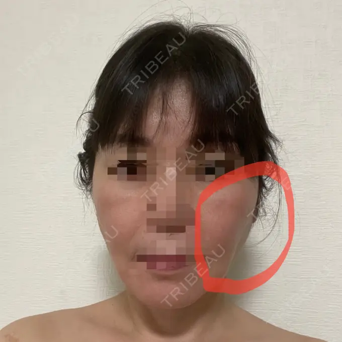 脂肪吸引（顔） / 切開リフト 恵聖会クリニック 京橋院 DAY 64 メイン用