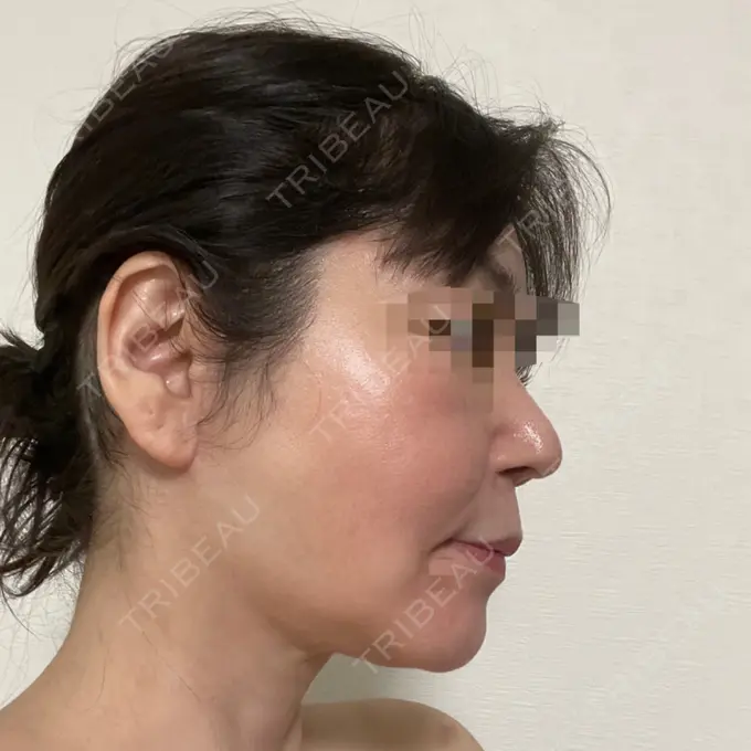 脂肪吸引（顔） / 切開リフト 恵聖会クリニック 京橋院 DAY 64 メイン用