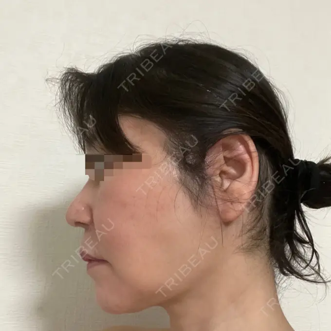 脂肪吸引（顔） / 切開リフト 恵聖会クリニック 京橋院 DAY 64 メイン用