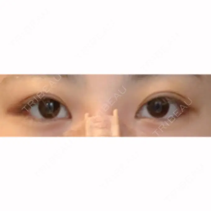 目尻切開 / タレ目形成・グラマラスライン（切開） / ボトックス（タレ目） A CLINIC（エークリニック） 銀座院 DAY 18 メイン用