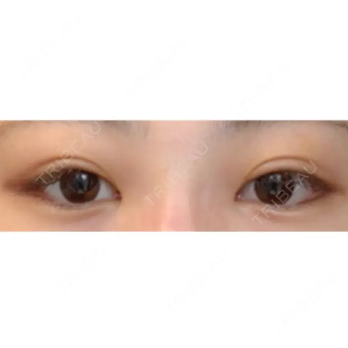 目尻切開 / タレ目形成・グラマラスライン（切開） / ボトックス（タレ目） A CLINIC（エークリニック） 銀座院 DAY 19 メイン用