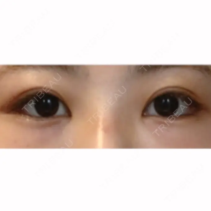 目尻切開 / タレ目形成・グラマラスライン（切開） / ボトックス（タレ目） A CLINIC（エークリニック） 銀座院 DAY 20 メイン用