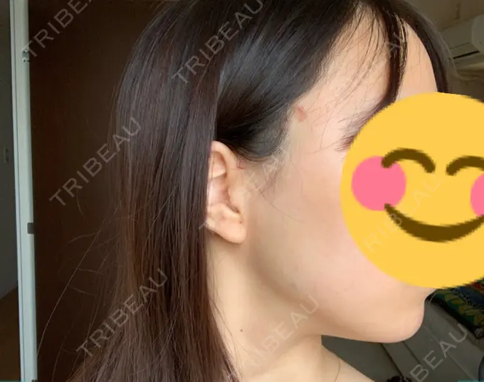 糸リフト / ボトックス（エラ・小顔） フローラクリニック DAY 0 メイン用