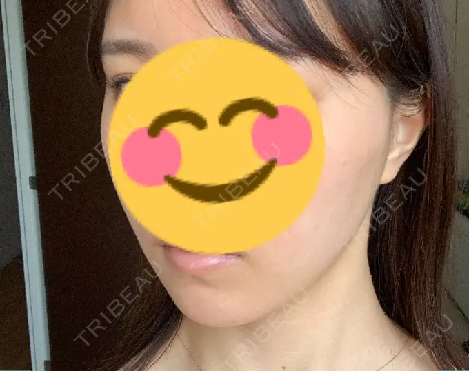 糸リフト / ボトックス（エラ・小顔） フローラクリニック DAY 0 メイン用