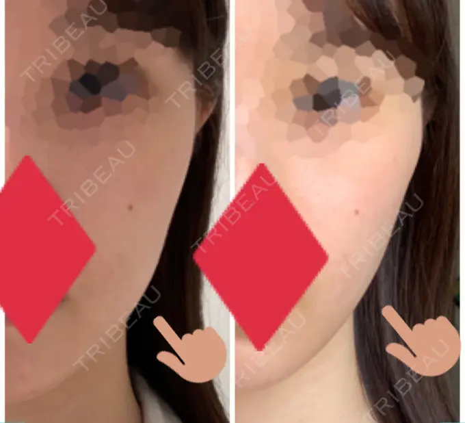 糸リフト / ボトックス（エラ・小顔） フローラクリニック DAY 1 メイン用