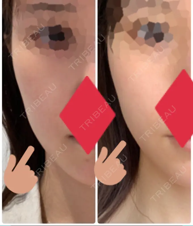 糸リフト / ボトックス（エラ・小顔） フローラクリニック DAY 1 メイン用