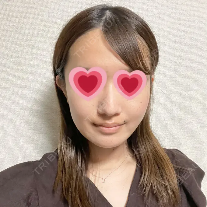 糸リフト / 脂肪吸引（顔） / メーラーファット除去 湘南美容クリニック 秋葉原院 DAY 14 メイン用