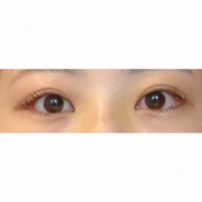 目尻切開 / タレ目形成・グラマラスライン（切開） / ボトックス（タレ目） A CLINIC（エークリニック） 銀座院 AFTER メイン用