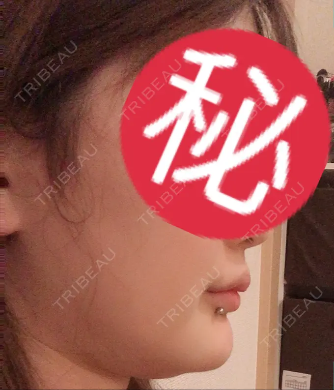 骨切り（あご） アーククリニック DAY 118 メイン用