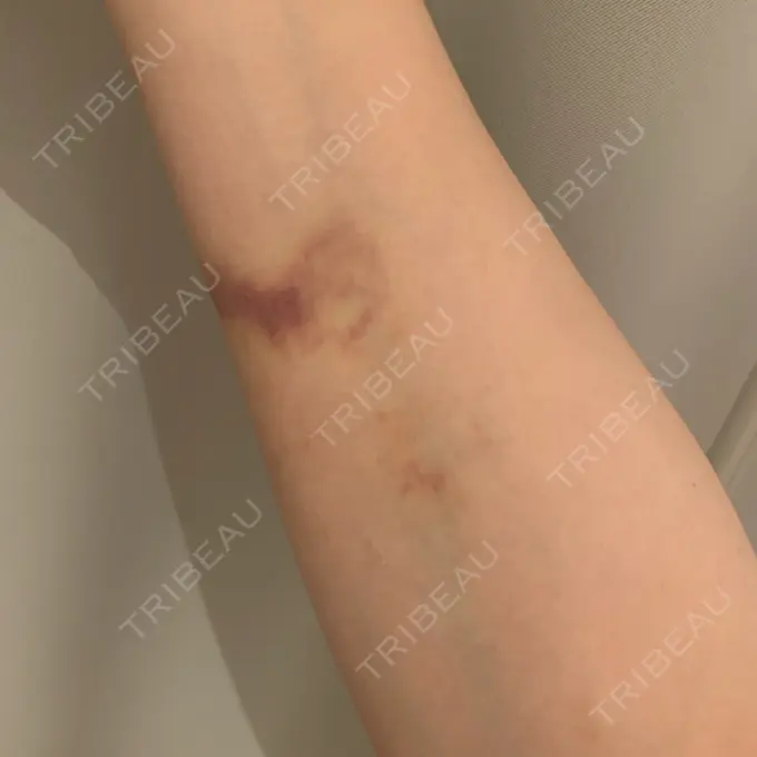 脂肪吸引（二の腕） THE CLINIC（ザ・クリニック） 福岡院 AFTER メイン用