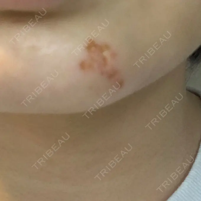 ほくろ・いぼ切除（肌） 新宿新南口れいわクリニック DAY 3 メイン用