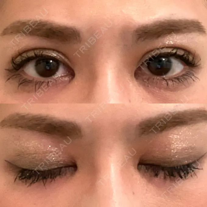 二重埋没 城本クリニック 福岡院 DAY 27 メイン用