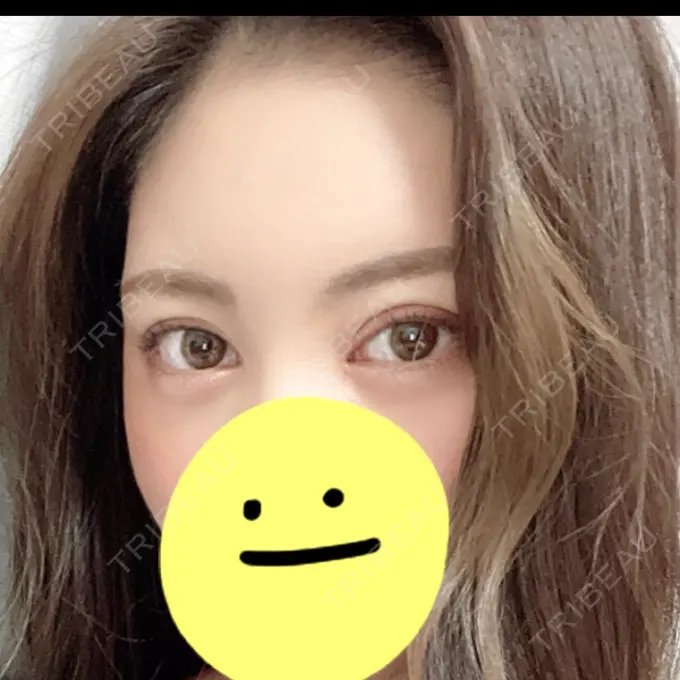 二重切開 / 目頭切開 / クマ治療 / バッカルファット除去 / 脂肪吸引（顔） / 額を丸く / 目尻切開 ヴェリテクリニック 名古屋院 AFTER メイン用