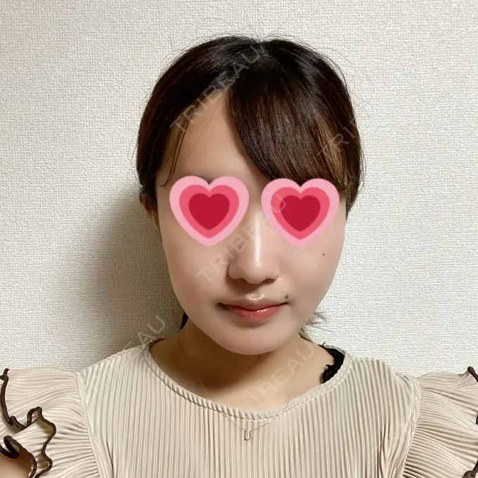 糸リフト / 脂肪吸引（顔） / メーラーファット除去 湘南美容クリニック 秋葉原院 DAY 17 メイン用