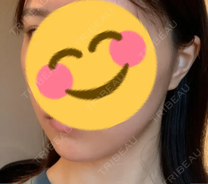 糸リフト / ボトックス（エラ・小顔） フローラクリニック DAY 7 メイン用