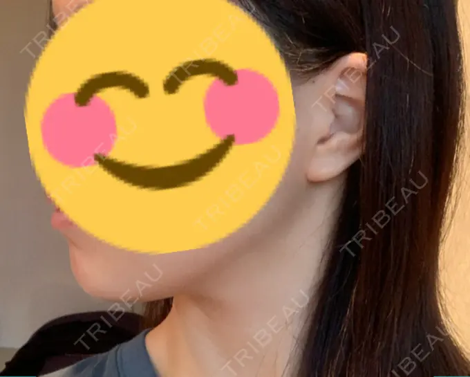 糸リフト / ボトックス（エラ・小顔） フローラクリニック AFTER メイン用