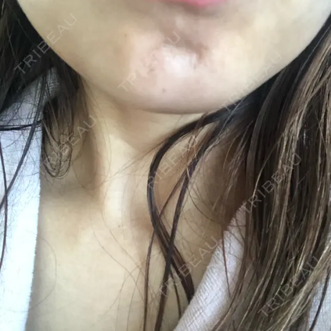 ボトックス（あご） フィラークリニック 横浜院 DAY 2 メイン用