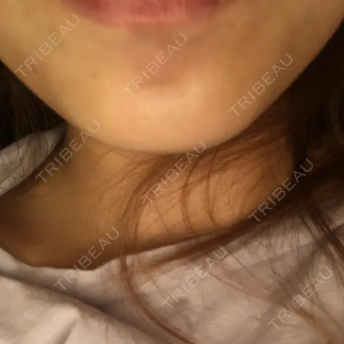 ボトックス（あご） フィラークリニック 横浜院 AFTER メイン用