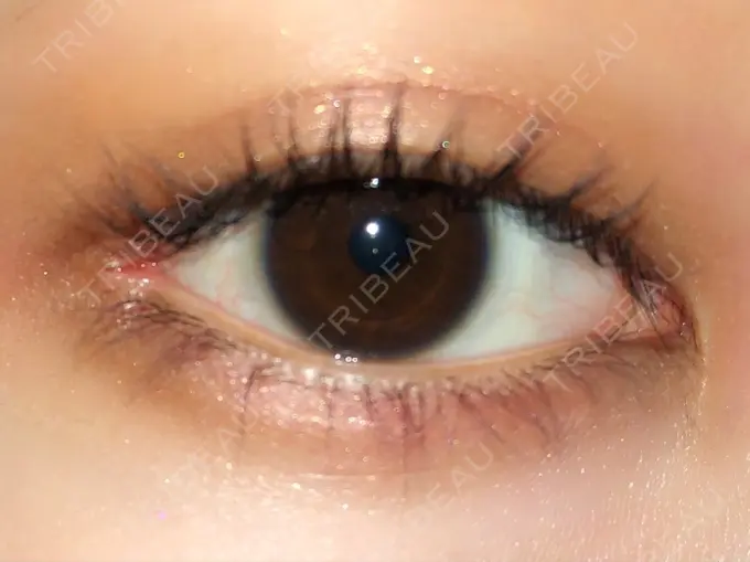 目頭切開 / 目尻切開 エートップ美容整形外科 DAY 261 メイン用